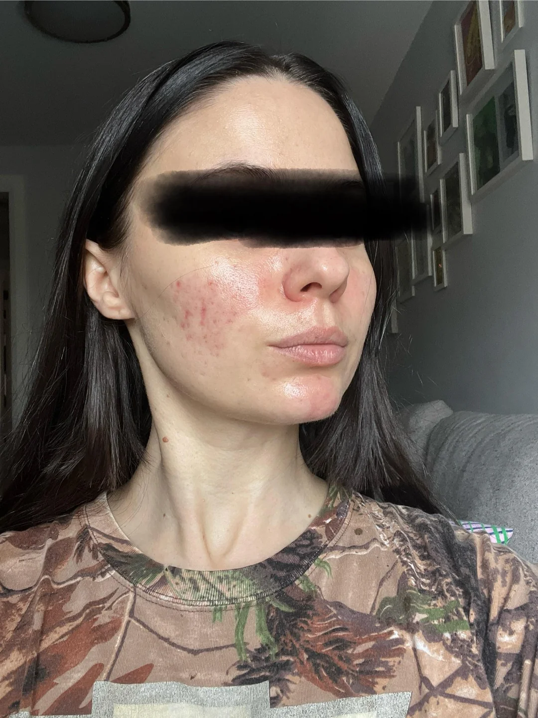 Rosacea after red light therapy