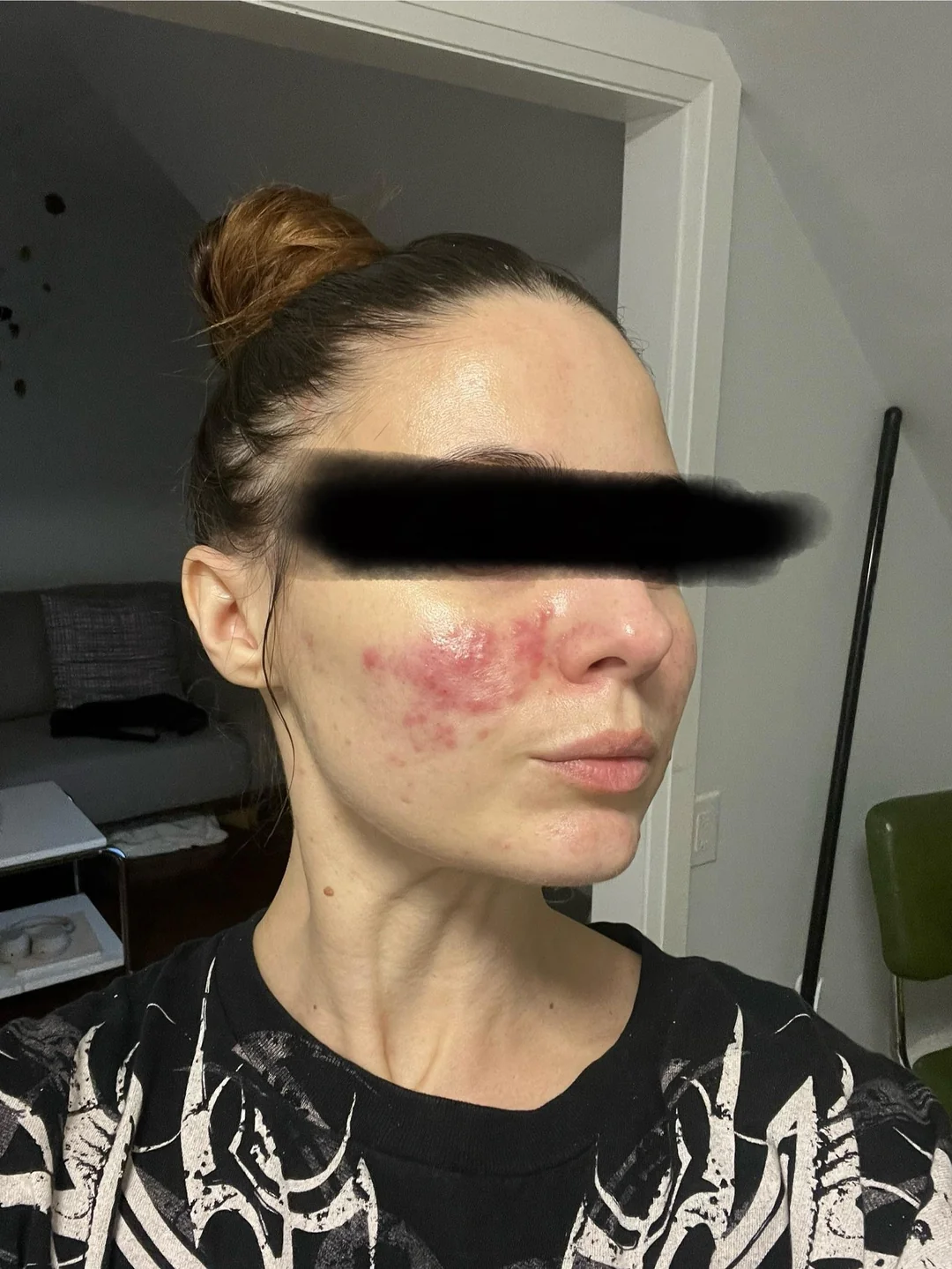Rosacea before red light therapy