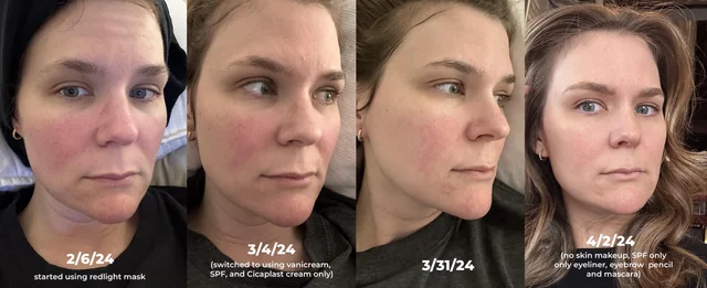 Red light therapy 4 stage progression